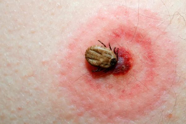 peligros-de-las-picaduras-de-garrapatas